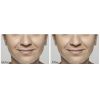Restylane® Lyft before and after