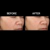 SkinMedica Lytera® 2.0 Before and After One