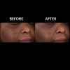 SkinMedica Lytera® 2.0 Before and After Three