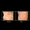 CoolSculpting B&A