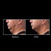 CoolSculpting Before and After 1