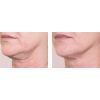 Nectifirm® before and after #2