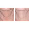 Nectifirm® before and after #3