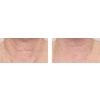 Nectifirm® before and after