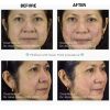 NovaThreads - Absorbable PDO Sutures