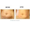 NovaThreads - Absorbable PDO Sutures