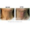 NovaThreads - Absorbable PDO Sutures