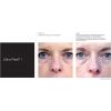 PCA Ultra Peel® I