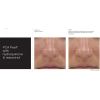 PCA Peel® with Hydroquinone & Resorcinol