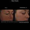 Pearl Treatment before after one