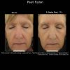 Pearl Treatment before after four