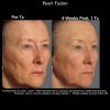 Pearl Treatment before after eight