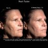 Pearl Treatment before after three
