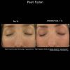 Pearl Treatment before after seven