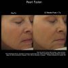Pearl Treatment before after five