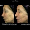 Pearl Treatment before after six