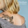 Laser Tattoo Removal Consultation