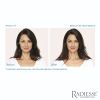 Radiesse before and after