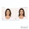 Radiesse before and after