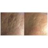 Rejuvapen - Acne Scarring