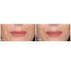 Restylane®-L before and after