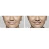 Restylane before and after