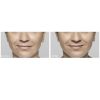 Restylane®-L before and after