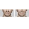 Restylane®-L before and after