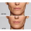 Restylane® Defyne™ (no Options)