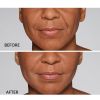 Restylane® Defyne™ (no Options)
