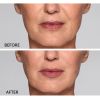 Restylane® Refyne Before and After