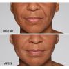 Restylane® Refyne Before and After