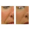 HydraFacial B&A
