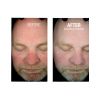 HydraFacial B&A