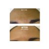 HydraFacial B&A