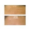 HydraFacial B&A