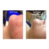 HydraFacial B&A
