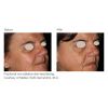 Resurfx before & after 1