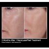 NanoLaserPeel Before & After 3