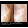 NanoLaserPeel Before & After 4