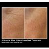 NanoLaserPeel Before & After 2