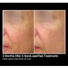 NanoLaserPeel Before & After 1