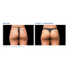 EMSCULPT®