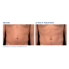 EMSCULPT®