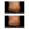 SculpSure® Before & After