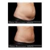 SculpSure® Before & After