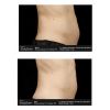 SculpSure® Before & After