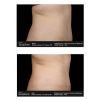 SculpSure® Before & After