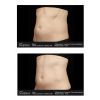 SculpSure® Before & After