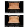 SculpSure® Before & After